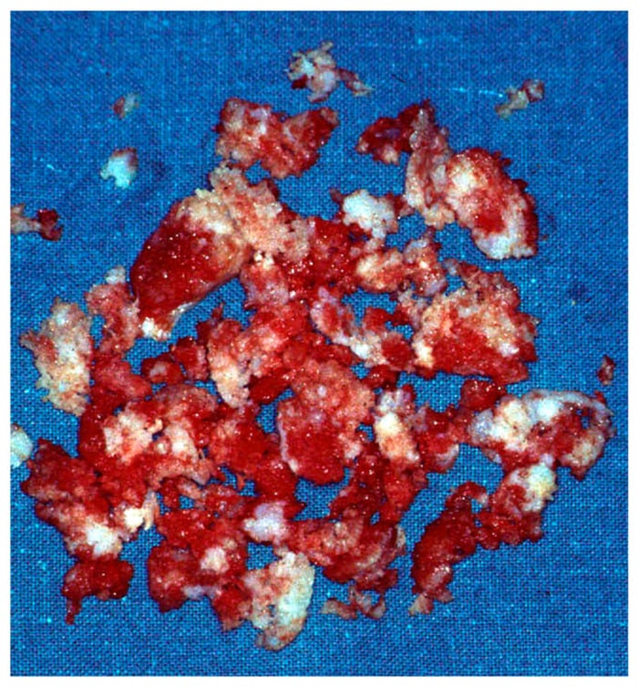 Gross curetted enchondroma fragments showing lobular white-blue cartilage