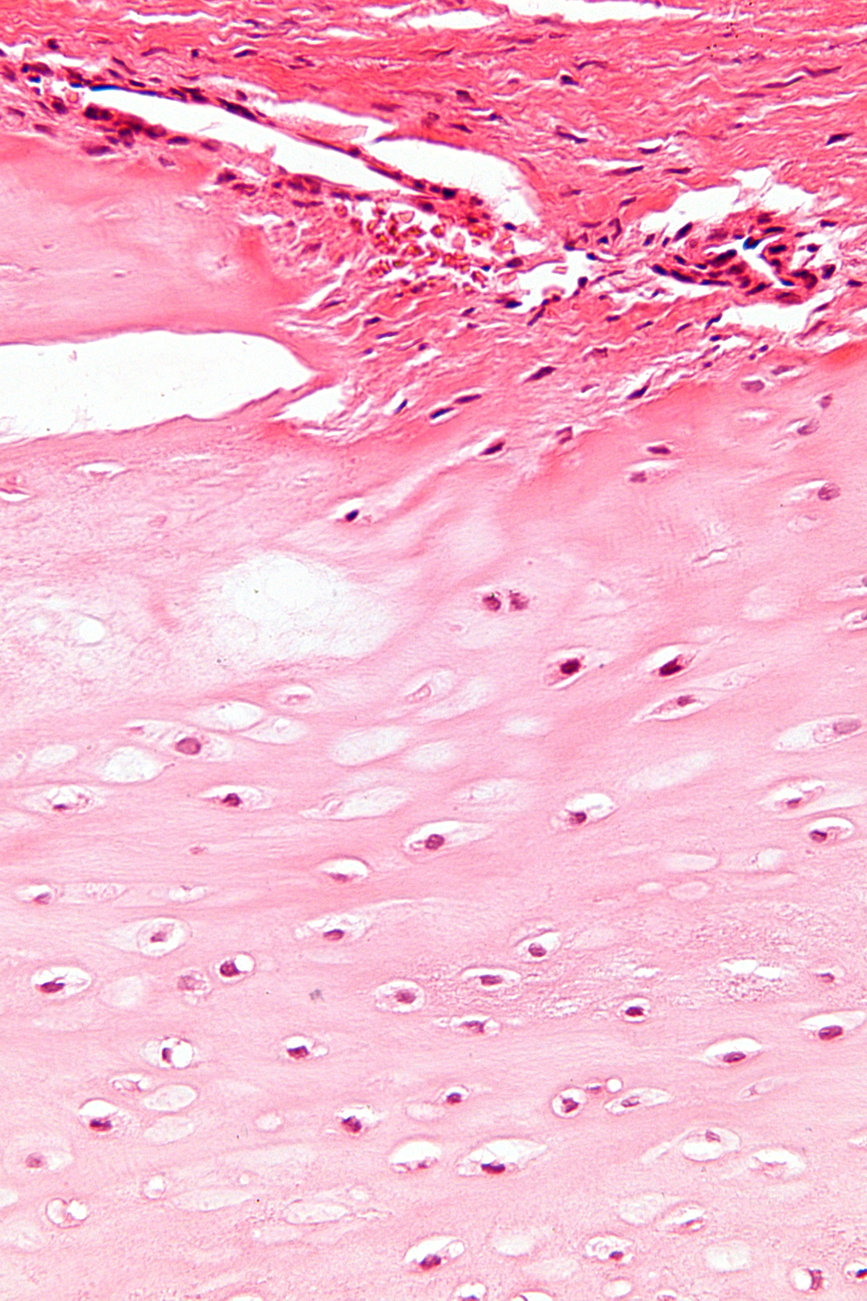 H&E histology of enchondroma showing hyaline cartilage with chondrocytes in lacunae.