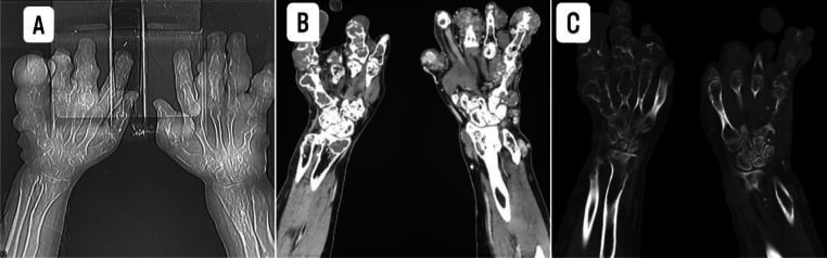 Scout radiograph and soft-tissue window showing extensive bilateral hand enchondromas with soft-tissue lesions in Maffucci syndrome
