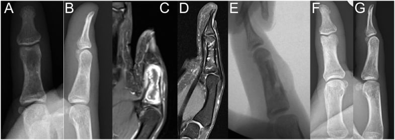 Preoperative, intraoperative and one-year radiographs of multiple enchondromas filled with cement