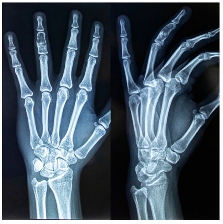 PA and lateral radiographs of an enchondroma in the middle phalanx of the ring finger