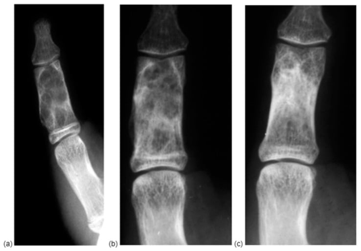 Serial radiographs after phalangeal curettage showing cancellous reconstruction at two months and remodelling at twelve months