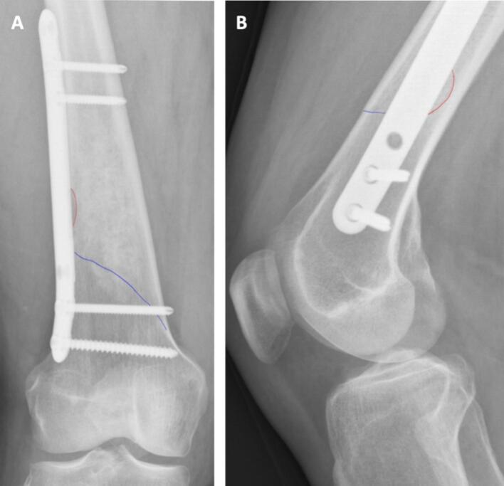 AP and lateral radiographs showing a cortical fissure after curettage despite prophylactic plate fixation