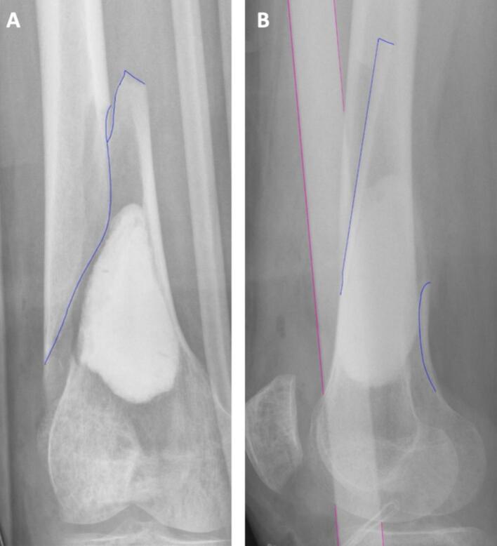 AP and lateral radiographs of a fracture after curettage and cement filling of an atypical cartilaginous tumour