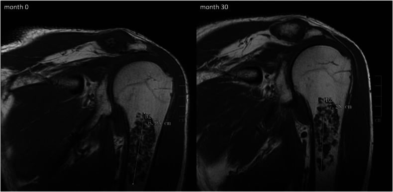 Coronal T1 MRI pair showing 3 mm craniocaudal growth of an atypical cartilaginous tumour over thirty months
