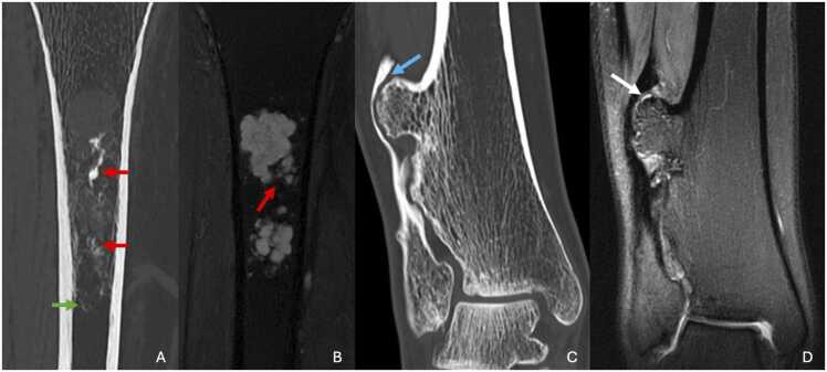 CT and MRI of a proximal tibial enchondroma with popcorn calcification and no endosteal scalloping beside an osteochondroma