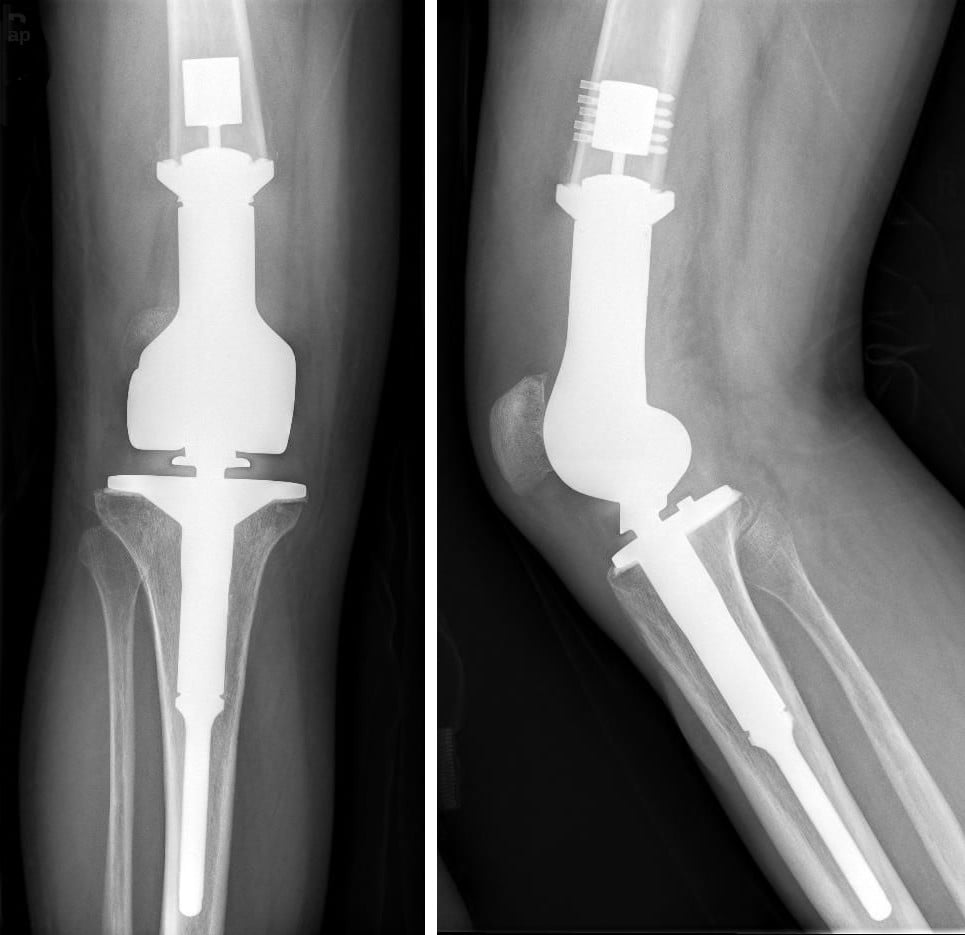 AP and lateral knee radiographs showing a distal-femoral endoprosthesis after wide resection of a malignant bone tumour.