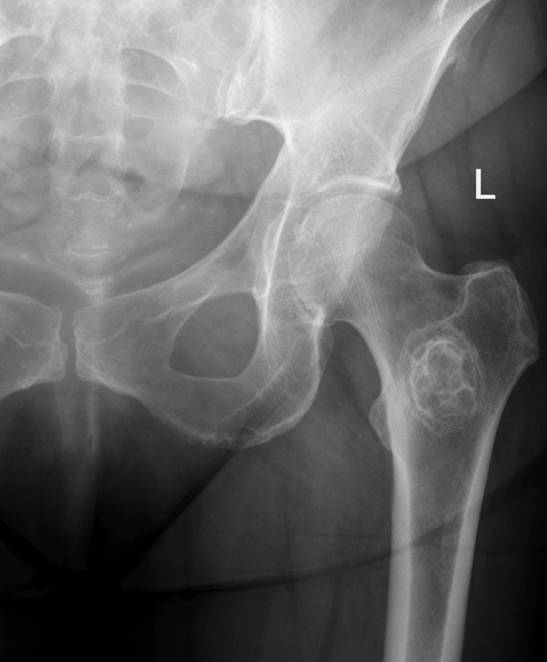 AP hip radiograph showing a lytic lesion in the proximal femur with a partly sclerotic rim.