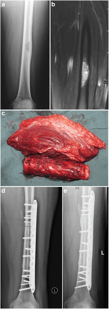 Ewing sarcoma of femoral diaphysis with treatment