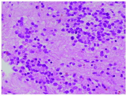 Ewing sarcoma histology showing small round blue cells