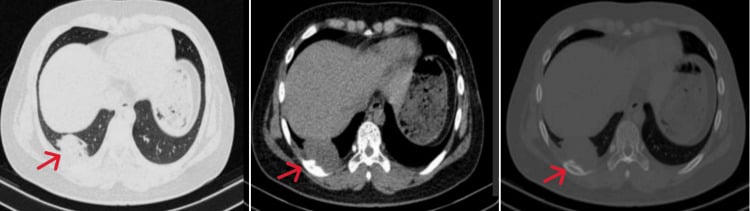 Axial chest CT in lung, mediastinal and bone windows showing an extraosseous Ewing sarcoma arising from the chest wall.