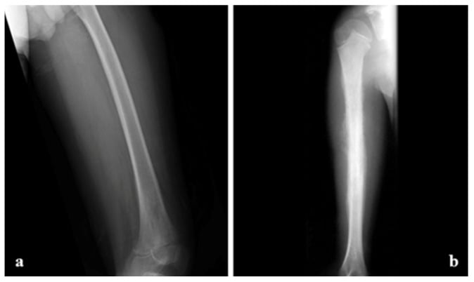 Long-bone radiographs demonstrating ill-defined Ewing sarcoma with permeative bone destruction, a wide transition zone and laminated onion-skin periosteal reaction.
