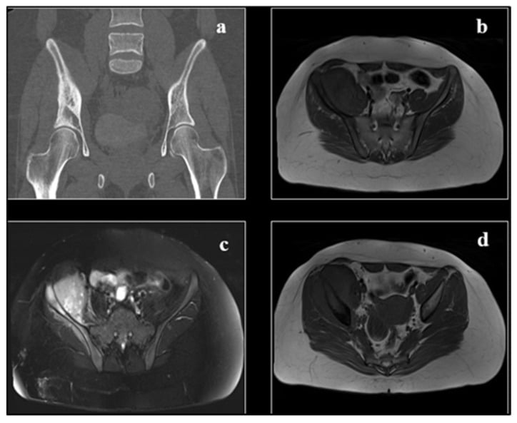 CT and MRI of pelvic Ewing sarcoma demonstrating cortical destruction, medullary infiltration and an extraosseous soft-tissue component.