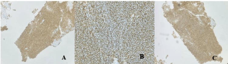 Immunohistochemistry panel of Ewing sarcoma showing NKX2.2 nuclear staining, strong membranous CD99 and FLI1 nuclear positivity.