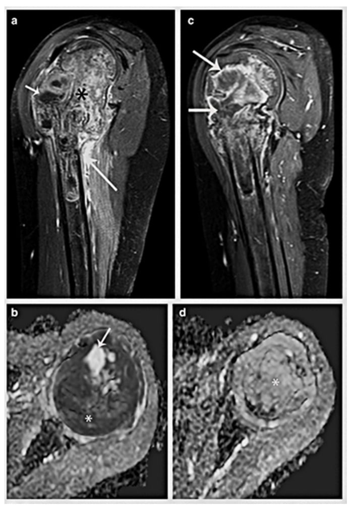 Coronal and axial MRI of proximal humeral Ewing sarcoma showing medullary disease, cortical breach and a large extraosseous soft-tissue mass.