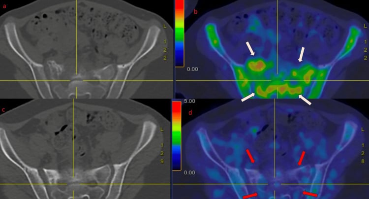 Paired PET-CT images before treatment and after completion of therapy for sacral Ewing sarcoma showing reduction in metabolic activity.