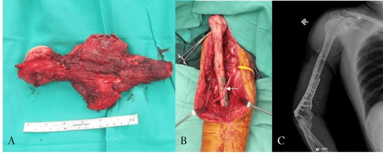 Operative and radiographic sequence of wide proximal-humerus Ewing sarcoma resection followed by osteoarticular allograft reconstruction.