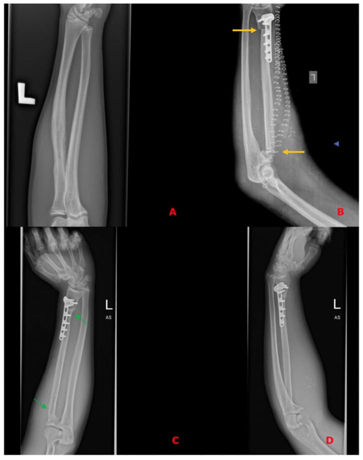 Serial forearm radiographs showing radial Ewing sarcoma before resection and reconstruction with a vascularised free fibular graft and plate fixation.