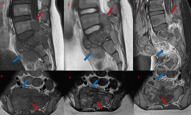 Multisequence sagittal and axial MRI of sacral Ewing sarcoma showing marrow replacement, neural-canal extension and heterogeneous enhancement.