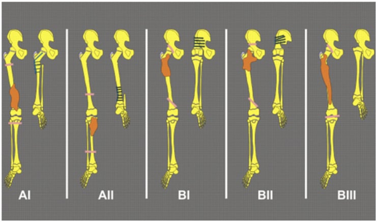 Diagram of Winkelmann rotationplasty types AI, AII, BI, BII and BIII according to the level of lower-limb tumour resection.