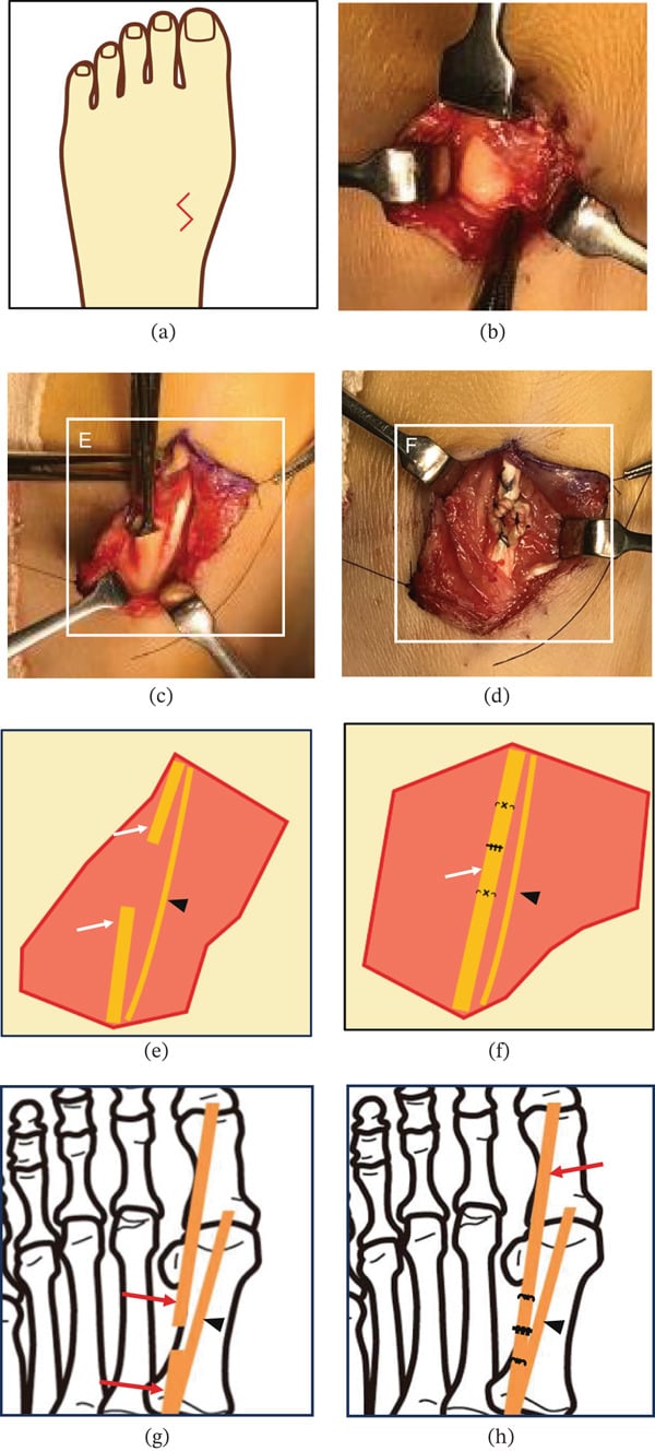 Panels (a) to (h): a schematic of a zigzag incision on the dorsum of the foot, operative photographs of the exposed EHL, and schematics in which white or red arrows mark the tendon ends and a black arrowhead marks an accessory extensor hallucis capsularis slip, before and after repair.