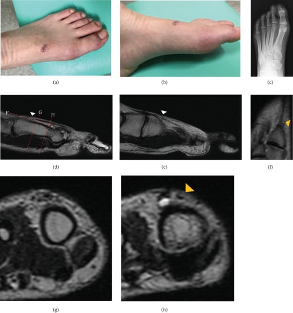 Composite of a small laceration on the dorsum of the foot, a foot radiograph and MRI images with arrowheads marking the EHL injury, panels (a) to (h).