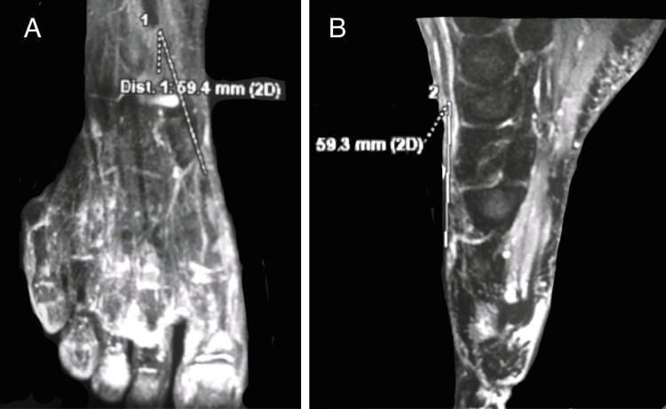 Two MRI views, A and B, each measuring the gap between the retracted ends of a ruptured extensor hallucis longus tendon at about 59 millimetres (59.4 mm and 59.3 mm).