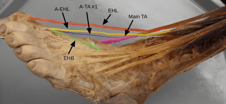 Cadaveric dissection of the dorsum of the foot with coloured overlays labelling the main tibialis anterior, extensor hallucis longus, extensor hallucis brevis and accessory tibialis anterior and extensor hallucis longus slips.