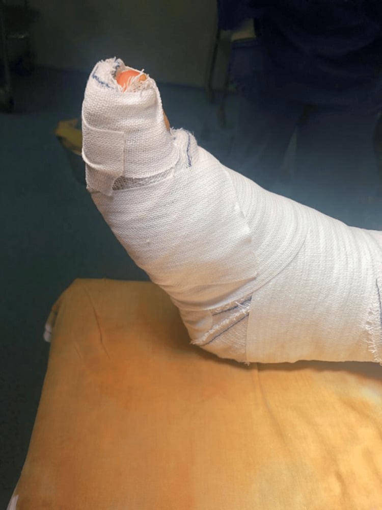 Foot and ankle immobilised in a bandaged splint after EHL tendon repair, the bandage extending over the hallux with the tip of the toe exposed