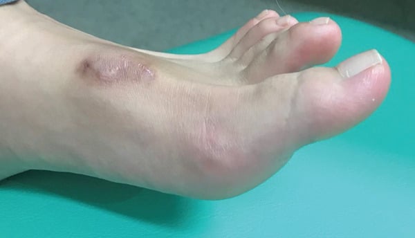 Clinical photograph at twelve weeks after EHL repair showing the hallux in active dorsiflexion without extension lag, with a healed scar on the dorsum of the foot