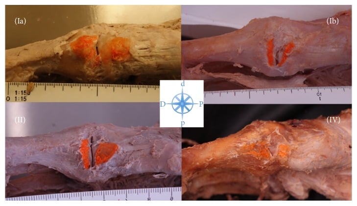 Four cadaveric specimens, labelled Ia, Ib, II and IV, with the tibialis anterior tendon insertion footprint painted orange, shown with scale rulers and an orientation rose