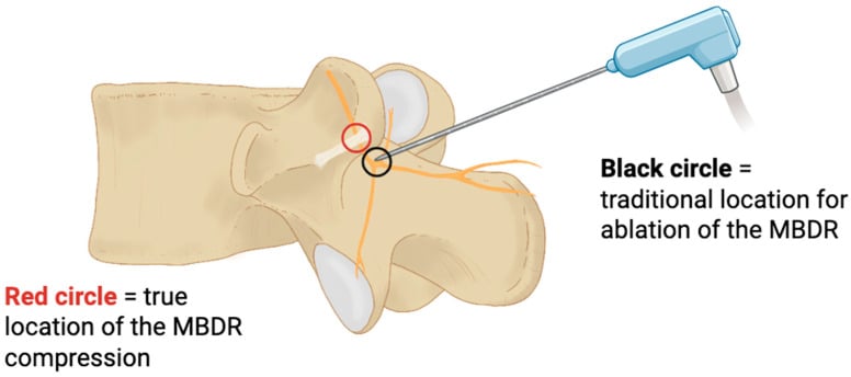Anatomical schematic diagram of mamillo-accessory ligament ossification and medial branch entrapment