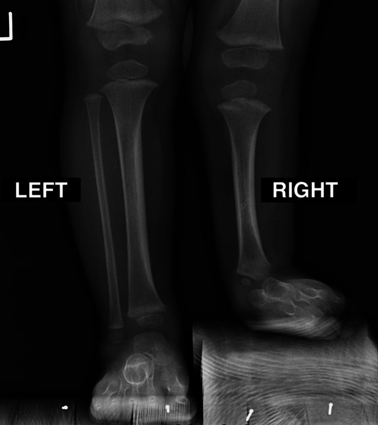 AP and lateral radiographs demonstrating severe fibular hemimelia with complete fibular absence and tibial bowing