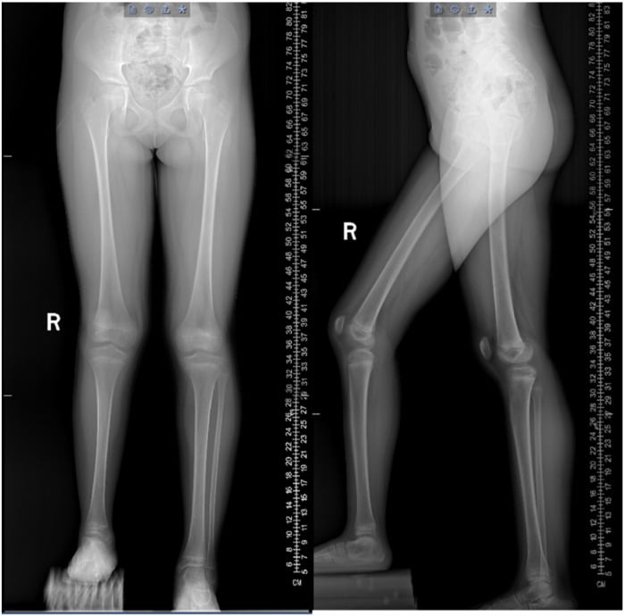 Preoperative full-length radiographs demonstrating lower limb length discrepancy and fibular absence
