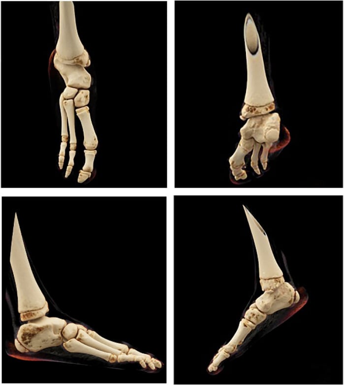 3D CT reconstruction demonstrating tarsal coalition and ball-and-socket ankle joint in fibular hemimelia