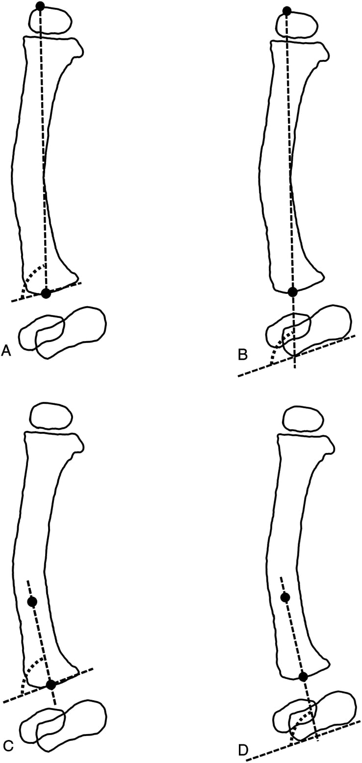 Radiographs demonstrating mechanical anterior distal tibial angle measurement in fibular hemimelia