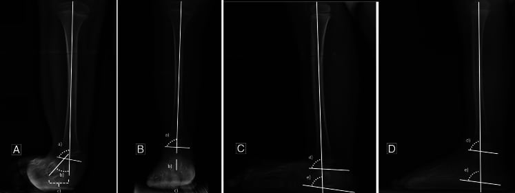 Radiographs showing ankle realignment before and 1 year after SUPERankle procedure