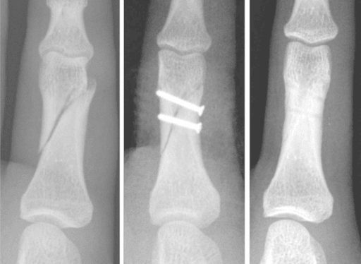 Lag screw fixation of an oblique phalangeal fracture