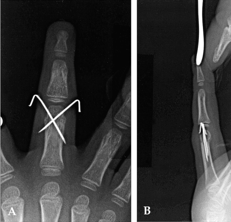 Crossed K-wire fixation of a phalangeal fracture