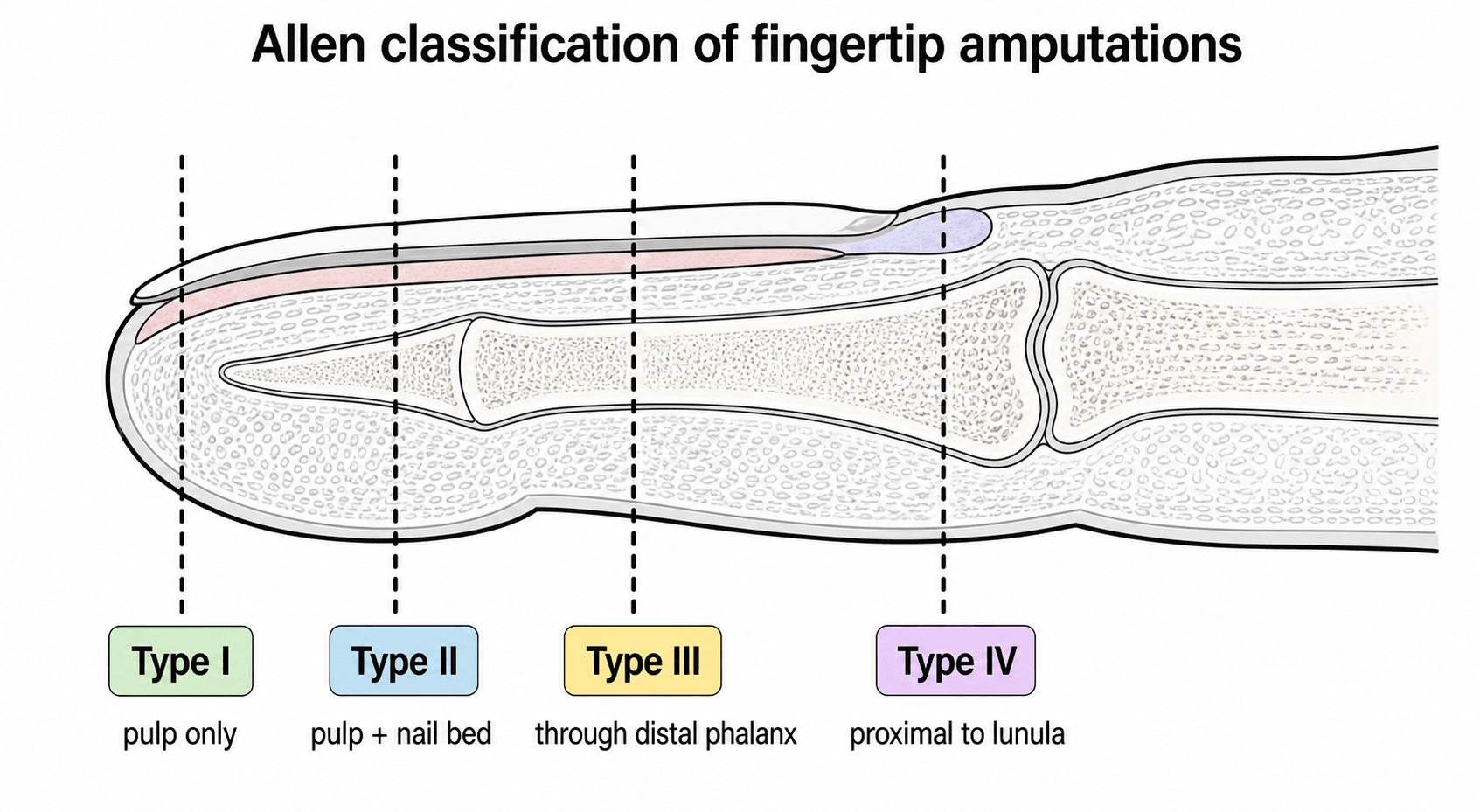 Lateral fingertip diagram showing the four Allen amputation levels: I pulp only, II pulp + nail bed, III through distal phalanx, IV proximal to lunula