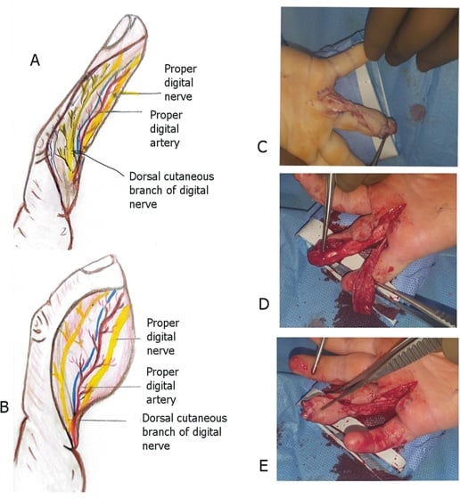 Anterograde neurovascular island flap anatomy and elevation
