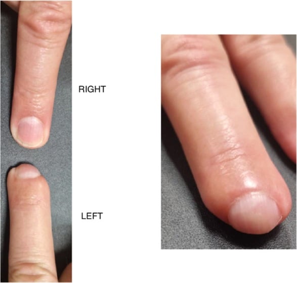 Claw nail after conservative healing of a proximal fingertip amputation