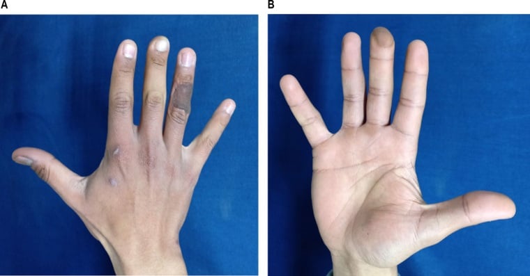 Cross-finger flap donor and recipient sites