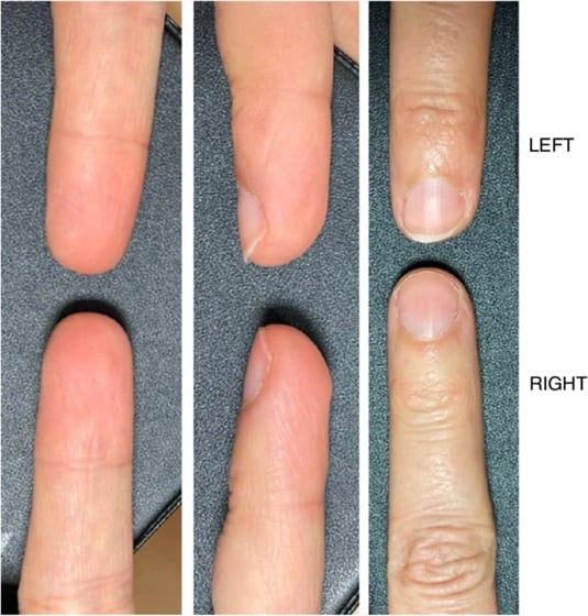 Pulp regeneration after occlusive dressing treatment
