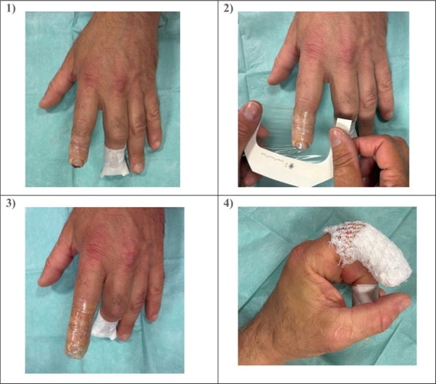 Occlusive dressing application for a fingertip amputation