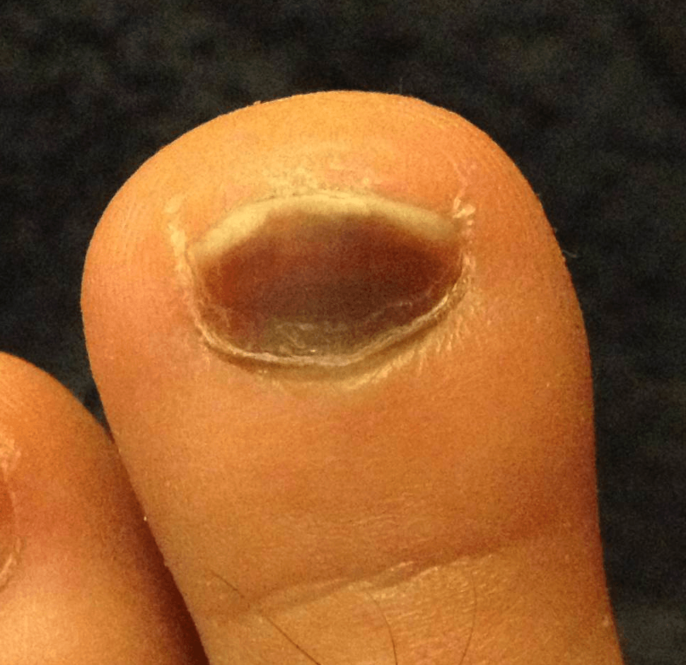 Clinical photograph of a subungual haematoma: dark blood collection beneath the nail plate.