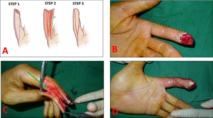 Triangular neurovascular unilateral advancement flap