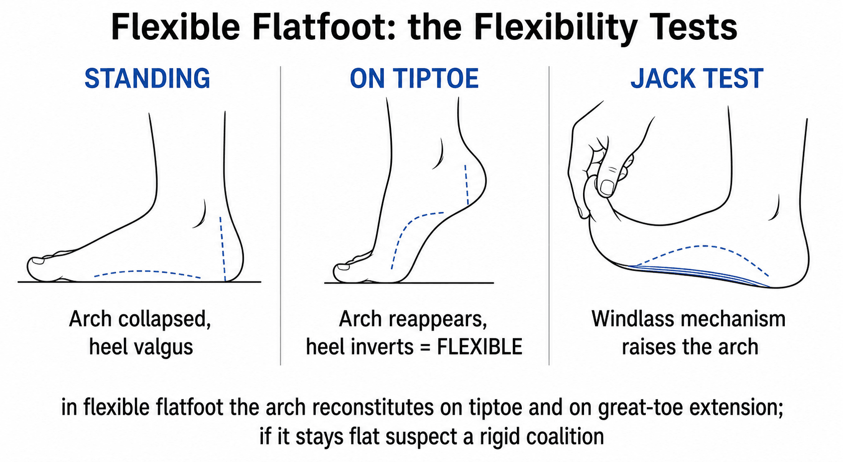 Three-panel schematic of the flexible-flatfoot flexibility tests: standing with a collapsed arch, arch restored on tiptoe with heel inversion, and the Jack great-toe-extension (windlass) test raising the arch.
