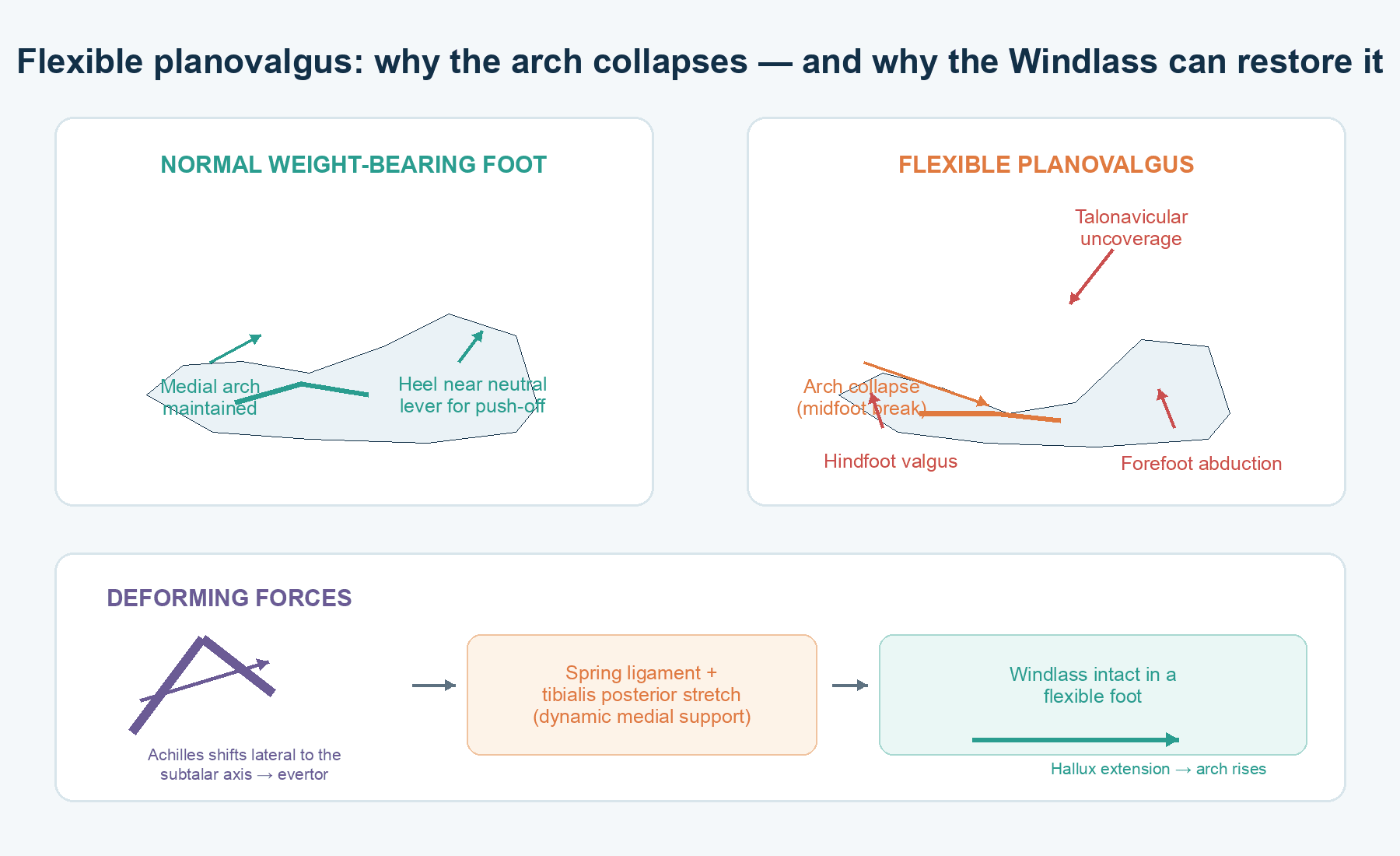 Original teaching schematic comparing a normal weight-bearing arch with flexible planovalgus and showing hindfoot valgus, forefoot abduction, talonavicular uncoverage, Achilles vector shift and Windlass restoration.