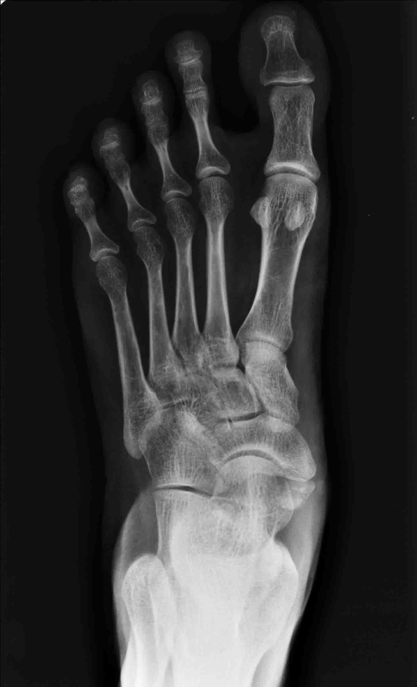 Dorsoplantar foot radiograph showing a prominent accessory navicular adjacent to the medial navicular.